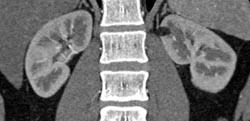 1 Cm Angiomyolipoma (AML) Kidney - CTisus CT Scan