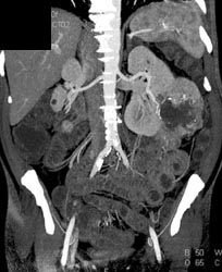 Renal Cell Carcinoma - CTisus CT Scan