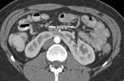 Horseshoe Kidney - CTisus CT Scan