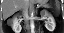 Cystic Renal Lesion - CTisus CT Scan