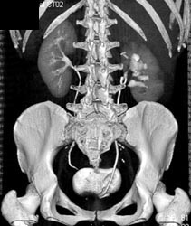 Renal Laceration - CTisus CT Scan