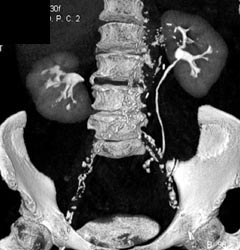 Atrophy in Right Kidney - CTisus CT Scan