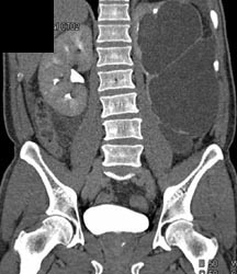 Cystic Dysplastic Left Kidney - CTisus CT Scan