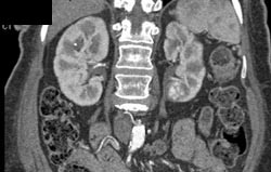 Scarring Left Kidney - CTisus CT Scan