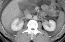 Retroaortic Renal Vein - CTisus CT Scan