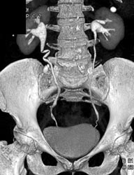 Kinked (normal) Right Ureter - CTisus CT Scan