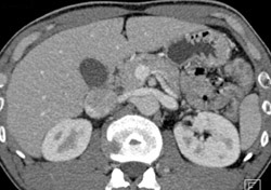 Retroaortic Left Renal Vein - CTisus CT Scan