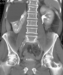 Renal Cyst - CTisus CT Scan