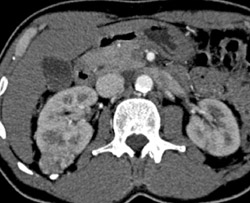 Renal Carcinoma - CTisus CT Scan