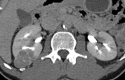 Renal Carcinoma - CTisus CT Scan