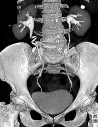 Tortuous Right Ureter - CTisus CT Scan