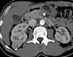 Renal Carcinoma - CTisus CT Scan