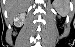 Renal Carcinoma - CTisus CT Scan