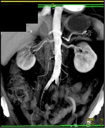 Renal Arteries: MIP Vs. VRT - CTisus CT Scan