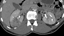 Renal Carcinoma - CTisus CT Scan