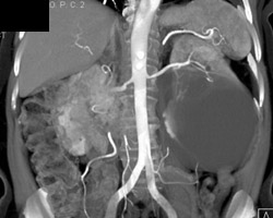 Stenosis of Left Ureter - CTisus CT Scan