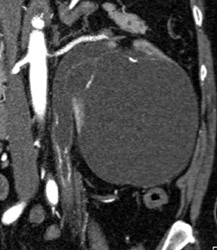 Stenosis Left Ureter Due to Prior Infection - CTisus CT Scan