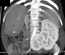 Pancake Kidney - CTisus CT Scan