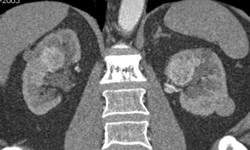 Bilateral Renal Tumors - CTisus CT Scan