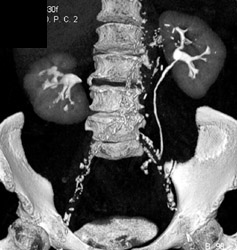 Scarring Right Kidney - CTisus CT Scan