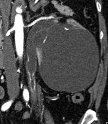 Dilated Renal Pelvis and Ureter - CTisus CT Scan