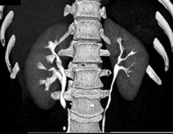 Ct Urogram With Duplicated Collecting System on Right - CTisus CT Scan