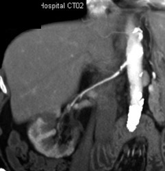 Renal Artery Stenosis - CTisus CT Scan