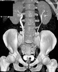 Dilated Ureters Due to Contracted Bladder and Enlarged Prostate - CTisus CT Scan
