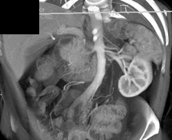 3 Left Renal Arteries - CTisus CT Scan