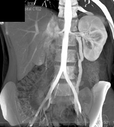 Prominent Left Gonadal Vein - CTisus CT Scan