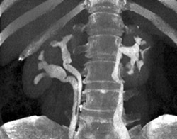 Duplicated Right Collecting System and Dilated Left Ureter - CTisus CT Scan