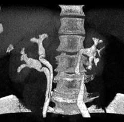 Duplicated Right Collecting System - CTisus CT Scan