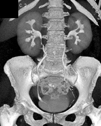 Ct Urography- Mildly Dilated Right Ureter - CTisus CT Scan