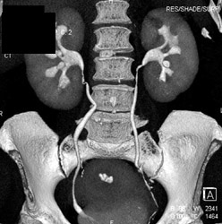 Normal CT Urogram - CTisus CT Scan