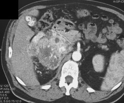 Renal Cell Carcinoma - CTisus CT Scan