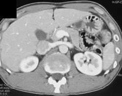 Normal CT at 35 Seconds Post Injection - CTisus CT Scan