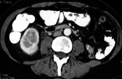 Transitional Cell Carcinoma - CTisus CT Scan