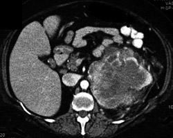 Renal Cell Carcinoma - CTisus CT Scan