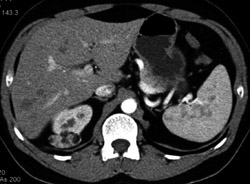 Angiomyolipoma (AML) of Kidney - CTisus CT Scan