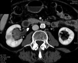 Transitional Cell Carcinoma - CTisus CT Scan