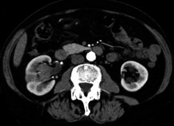 Transitional Cell Carcinoma - CTisus CT Scan