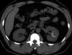 Renal Carcinoma - CTisus CT Scan