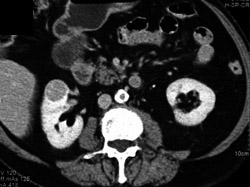 Renal Carcinoma - CTisus CT Scan