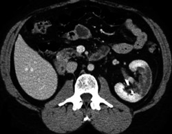 Renal Infarct - CTisus CT Scan