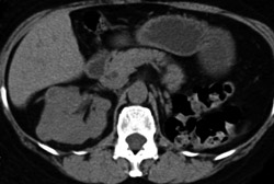 Multiple Metastases to the Right Kidney - CTisus CT Scan