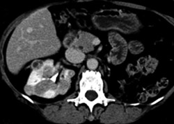 Multiple Right Renal Metastases - CTisus CT Scan