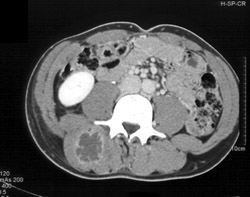 Paraspinal Muscle Abscess Incidentally Detected - CTisus CT Scan