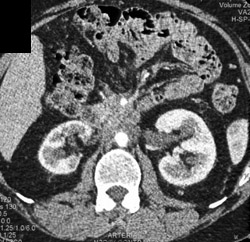 Retroperitoneal Fibrosis - CTisus CT Scan