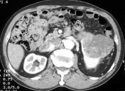 Renal Cell Caricinoma - CTisus CT Scan