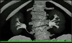 Ct Urogram - CTisus CT Scan